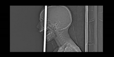 BAŞINA DEMİR ÇUBUK SAPLANAN ÇOCUĞUN SAĞLIK DURUMU İYİ